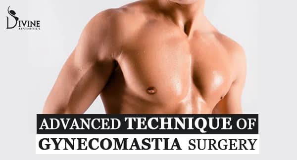 Most Advanced Technique of Gynecomastia Surgery by Dr. Amit Gupta