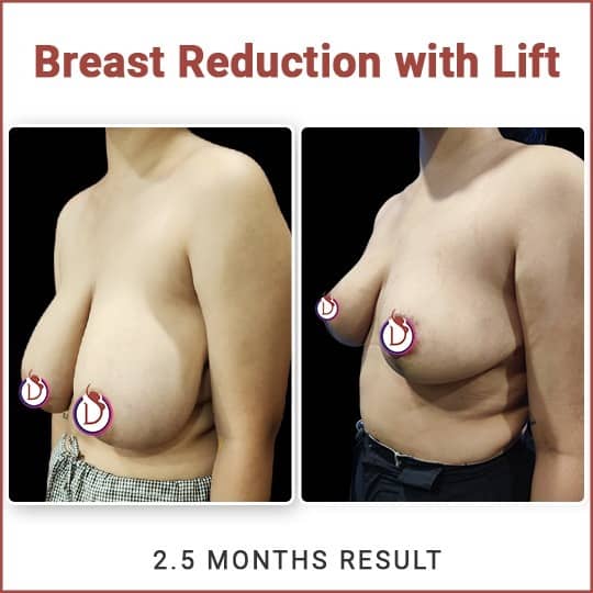Breast Reduction Surgery Cost in India