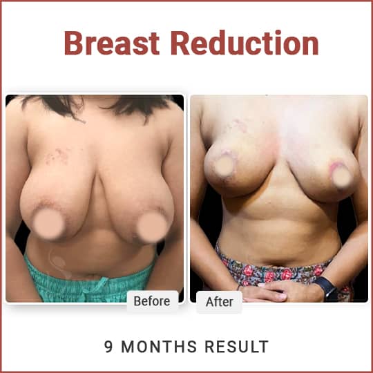 Breast Reduction Surgery Result in India