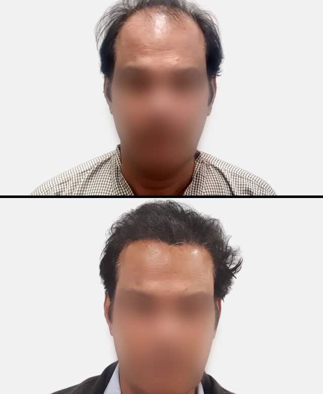 Long Hair Transplant Before and After