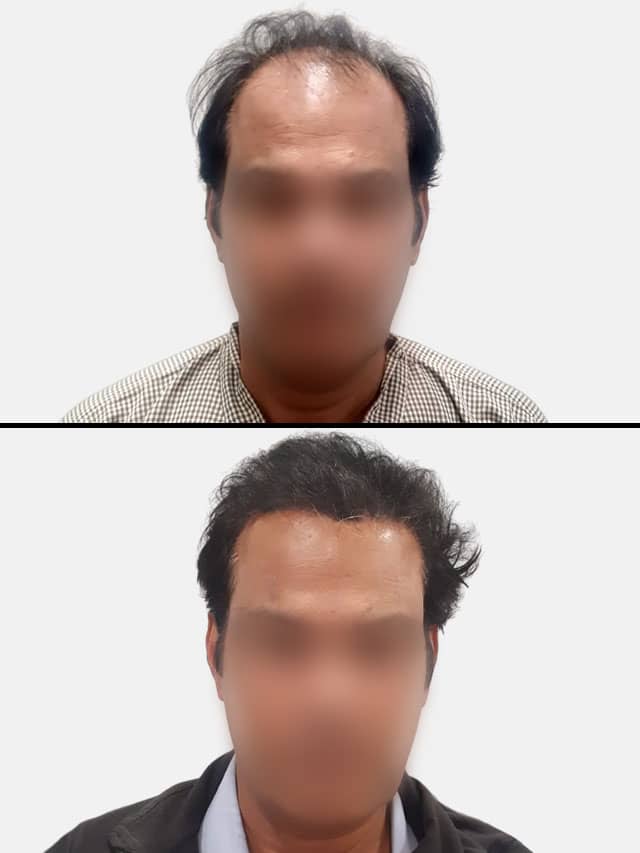 Before and After Hair Transplant | 10 Best Hair Transplant Results in India