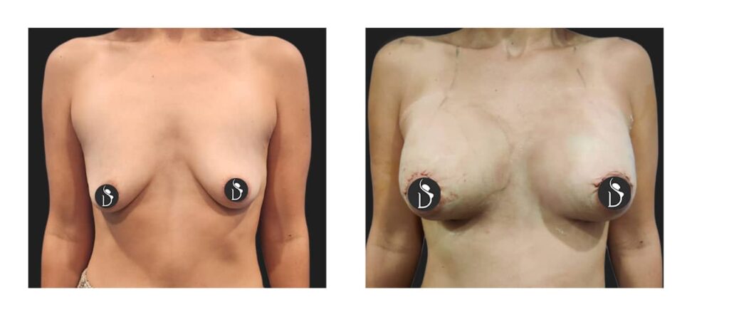 Breast Augmentation Case Study: 365 Breast Implants with Lift Result in India