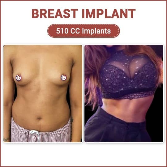 before and after transgender breast implant