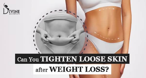 Tightening Loose Skin After Weight Loss