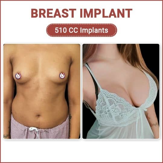 Breast Implant Surgeon in India