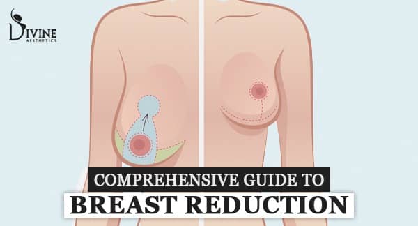 Comprehensive Guide To Breast Reduction