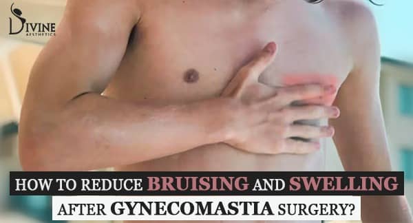 How To Reduce Swelling And Bruising After Gynecomastia