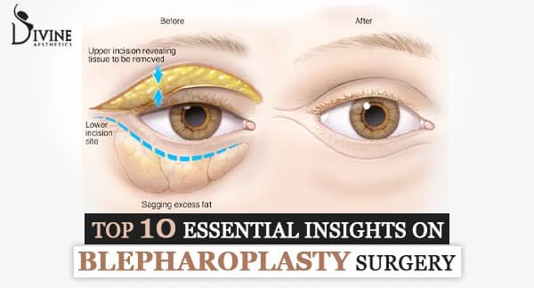 op Ten Essential Insights On Blepharoplasty Surgery