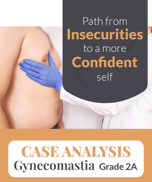 Gynecomastia Case Study