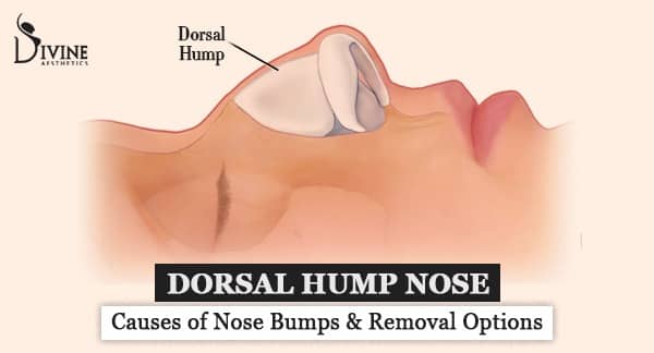 Dorsal Hump Nose – Causes of Nose Bumps & Removal Options