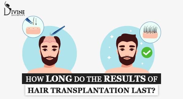 How long do the results of hair transplantation last?