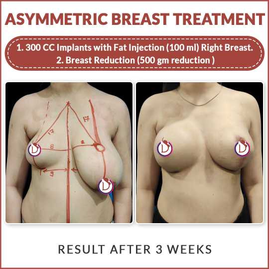 breast asymmetry before and after