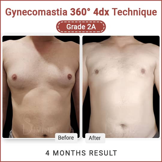 Rajiv Gynecomastia Journey and result