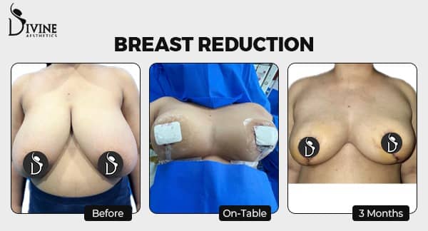 Sharman’s Journey to Breast Reduction