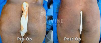 Male BBL Before and After