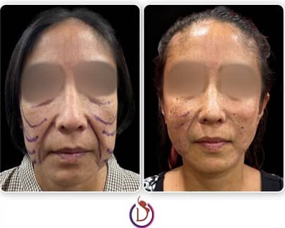 thread face lift result