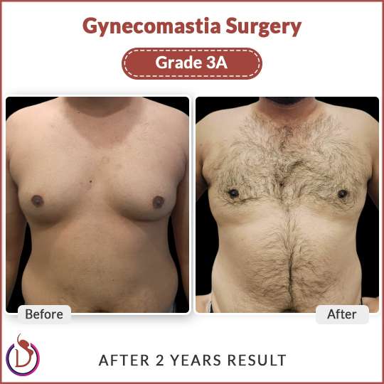 Best Gynecomastia Doctor in Delhi
