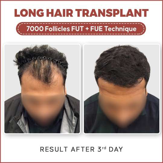 Get a Hair Transplant in Delhi