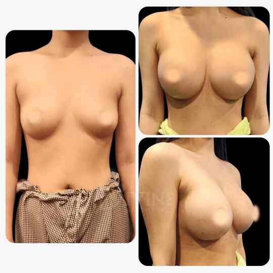 Hybrid Breast Augmentation