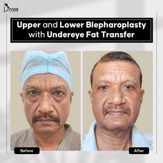 Combine Upper and Lower Eyelid Surgery