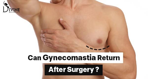 Can Gynecomastia Return After Surgery