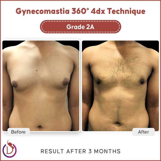 Gynecomastia Surgery Cost in India