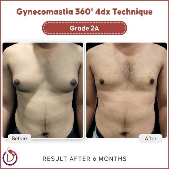 gynecomastia result with skin lift