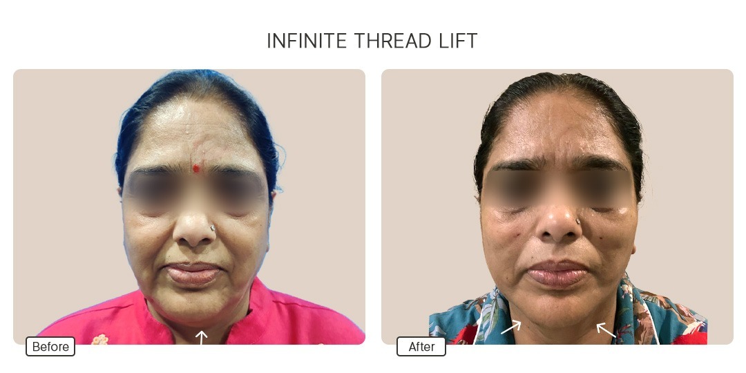 Infinite Threadlift
