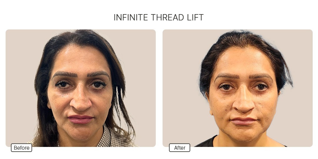 Infinite Threadlift