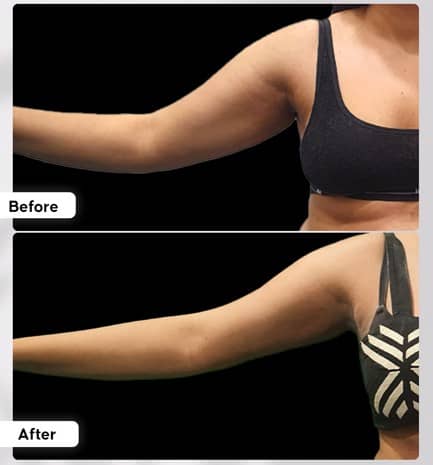 Arm Liposuction Before and After