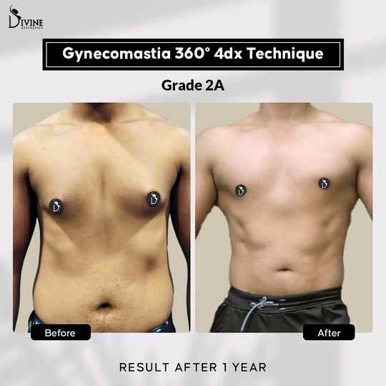 gynecomastia surgery result , can gynecomastia come back