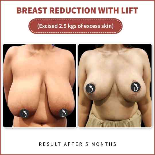 breast reduction surgery details