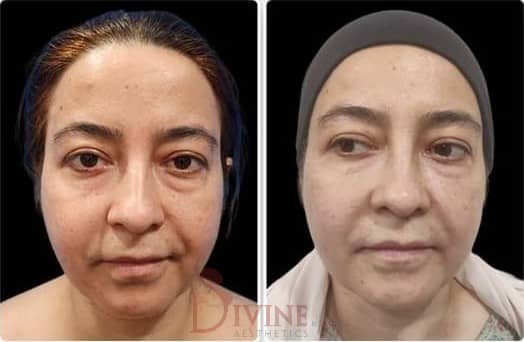 Buccal Fat Pad Removal Before and After