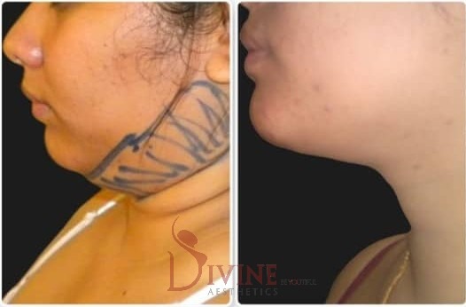 Face liposuction before and after