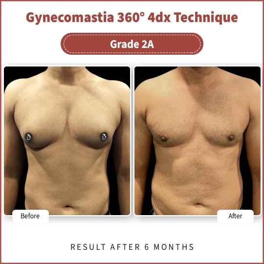 Gynecomastia Insurance