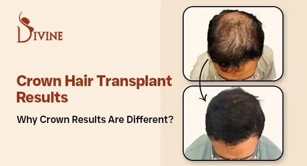 Crown Hair Transplant
