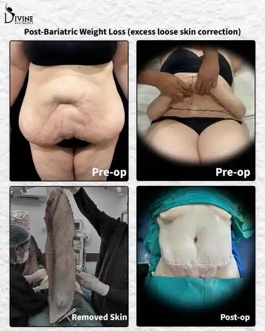 Loose Skin After Weight Loss Treatment Before and After