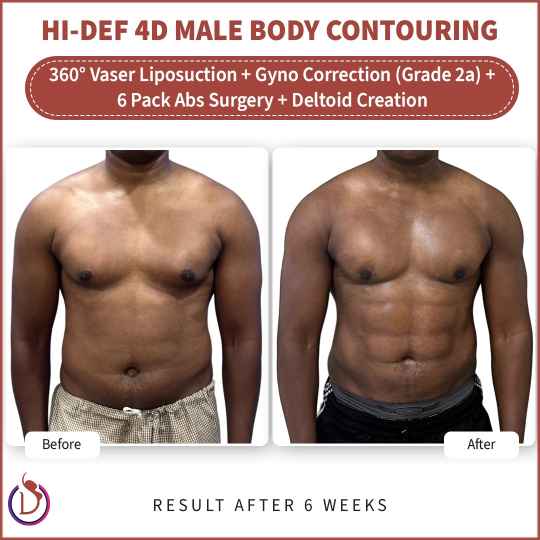 Six pack abs etching result in India