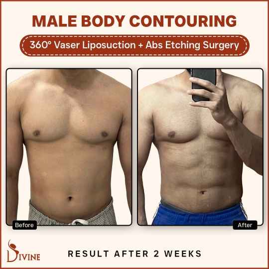 6 Pack Abs Surgery Before and After India