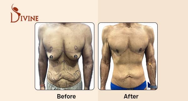 Tummy Tuck and Reverse Tummy Tuck Before and After