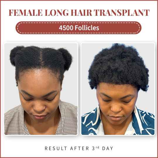 female hair transplant before after Delhi