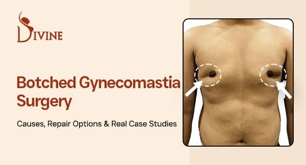 Botched Gynecomastia Surgery- Real Repair Cases