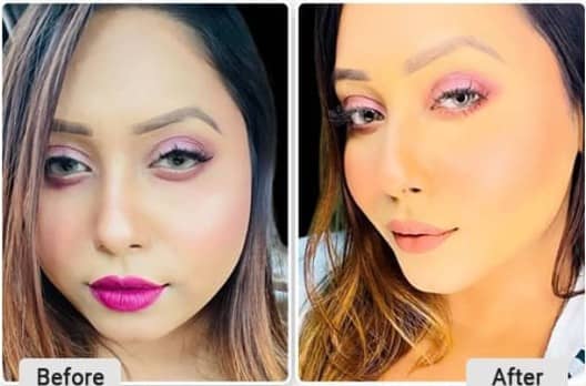 Buccal Fat Pad Removal Before and After