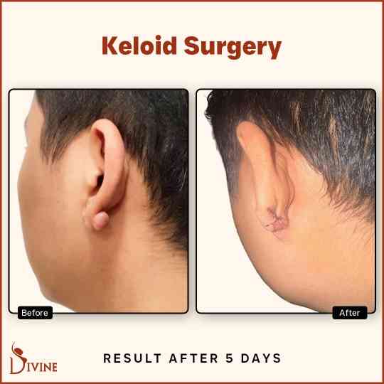 ear keloid surgery before after