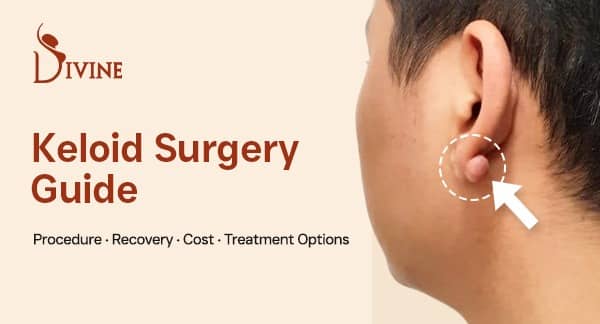 Keloid Surgery: Procedure, Recovery, Cost & Best Treatment Options