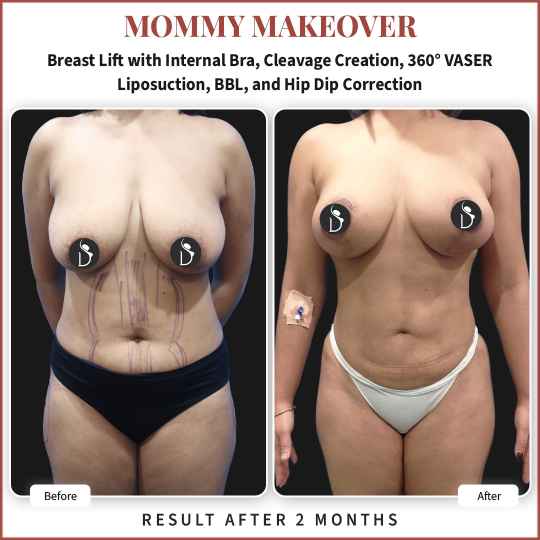 Mommy makeover before and after result