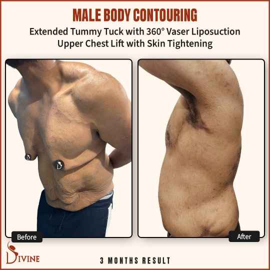 Tummy Tuck for Men Before and After
