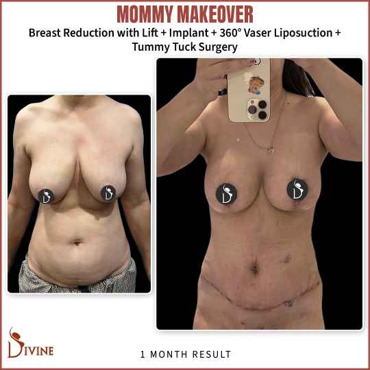 Mommy makeover Before and After Photo Delhi