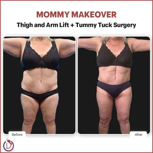 Mommy makeover Result