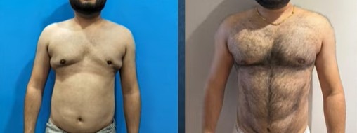 botched gynecomastia surgery asymmetry before after revision surgery chest contour repair